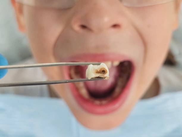 Best Dentist for Tooth Abscess  in Franklin Lakes, NJ